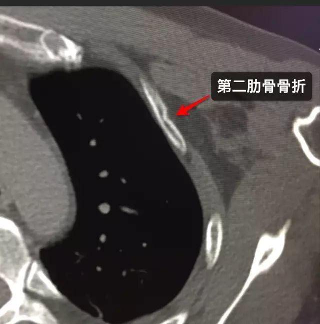 那些年 你漏诊过的肋骨骨折 腾讯新闻