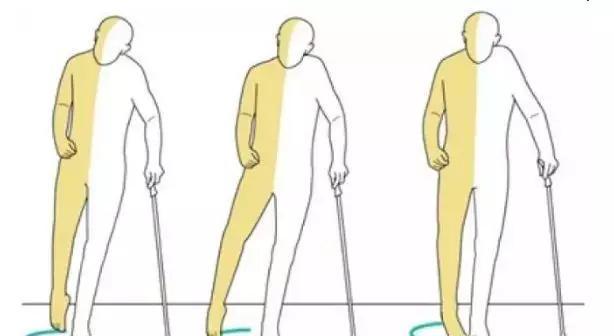 偏瘫后不想走路姿势怪异记住这3点让你越走越好看