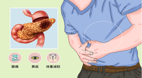 胰腺癌有哪些症狀:60%患者以腹痛為首發症狀,病程中有90%患者出現腹痛