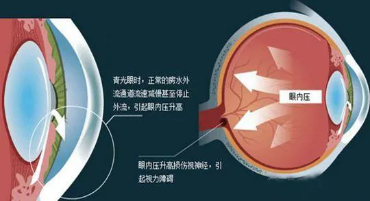 兰州爱尔实用科普：正确认识青光眼(图2)