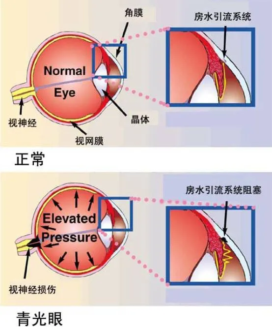 兰州爱尔实用科普：正确认识青光眼(图4)