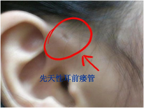 民间俗称的"耳仓 竟是一种先天性耳疾|耳前瘘管|耳仓|瘘管|炎症