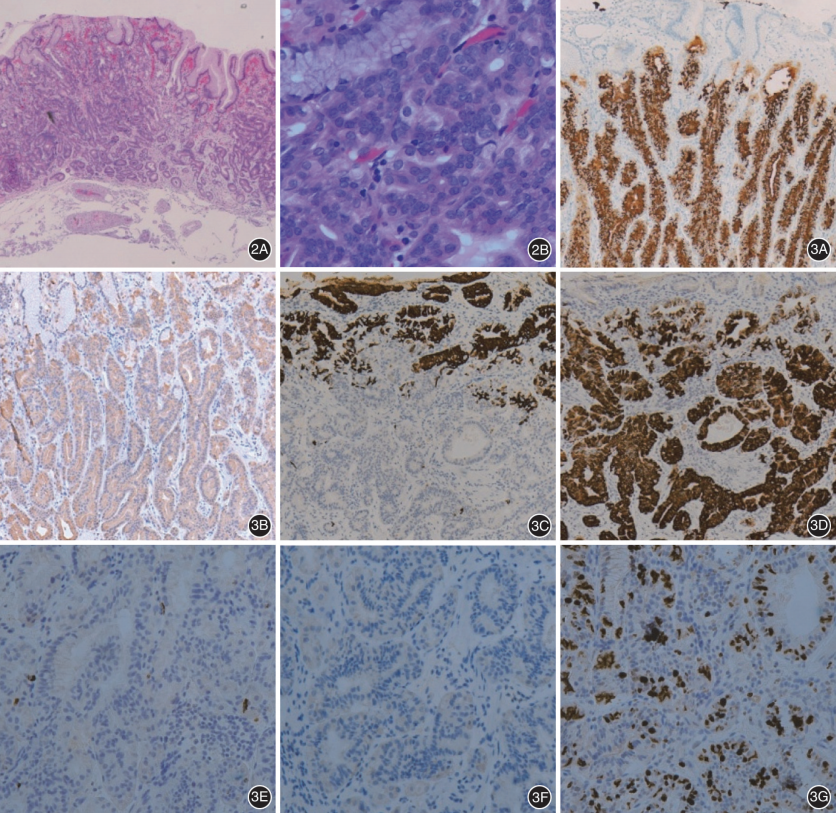 202108病例蓝光成像内镜下诊治胃底腺型胃癌一例