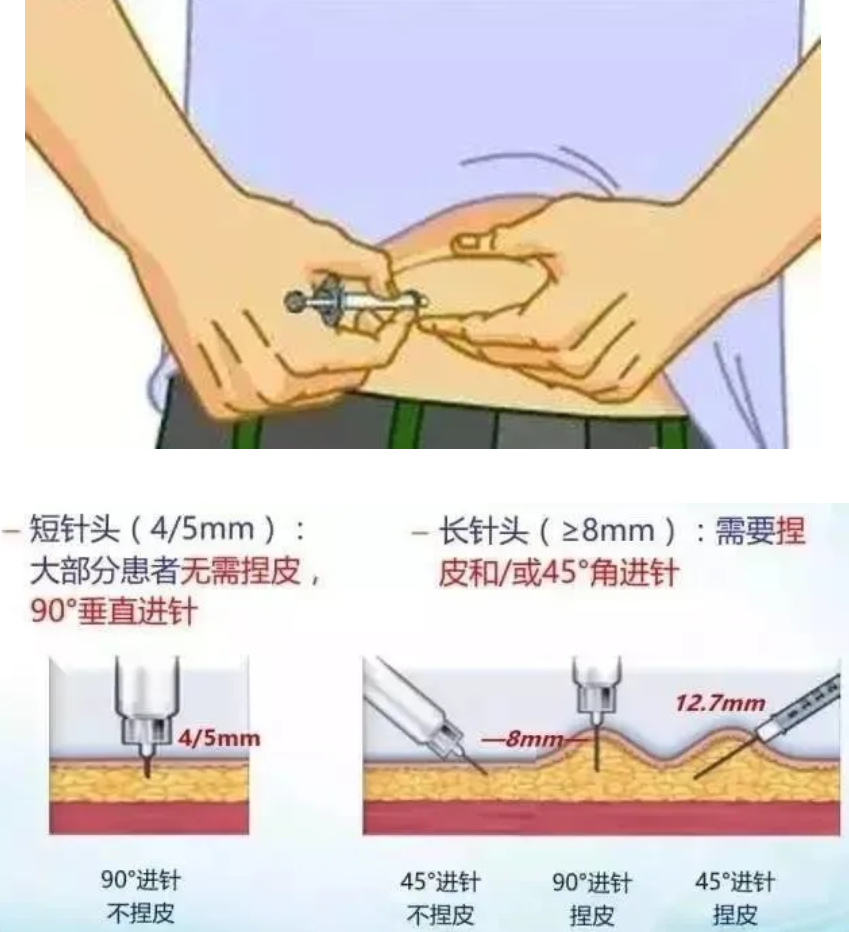 胰岛素手臂注射部位图片
