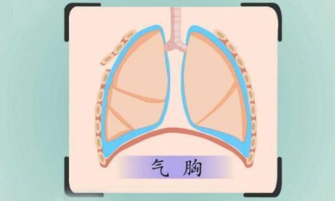 什么是自发性气胸严重吗看完这篇文章你就明白了