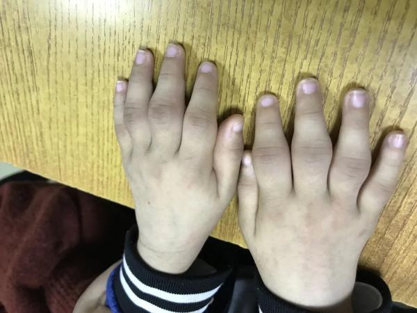 关节炎是中老年专利4岁男孩也中招