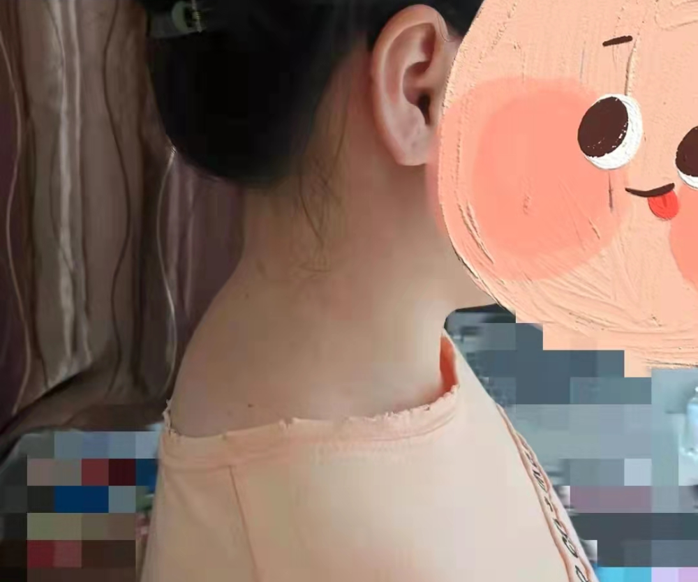 而且,侧面看整个人是就是驼背 头前伸状态.