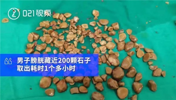 男子患膀胱结石身体藏近200颗 重量达195克