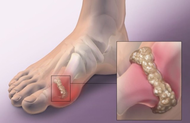 痛風患者為什麼晚上更易疼痛經常第一蹠趾關節好發呢