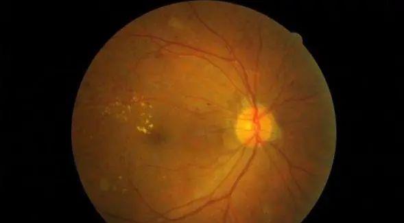 羟氯喹视网膜病变图片
