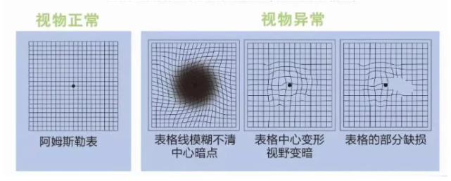 实用科普：“黄斑”不是“斑”，兰州爱尔专家为你揭秘黄斑病！(图2)