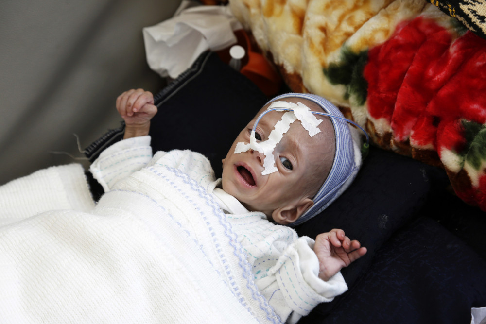 国际也门营养不良的儿童