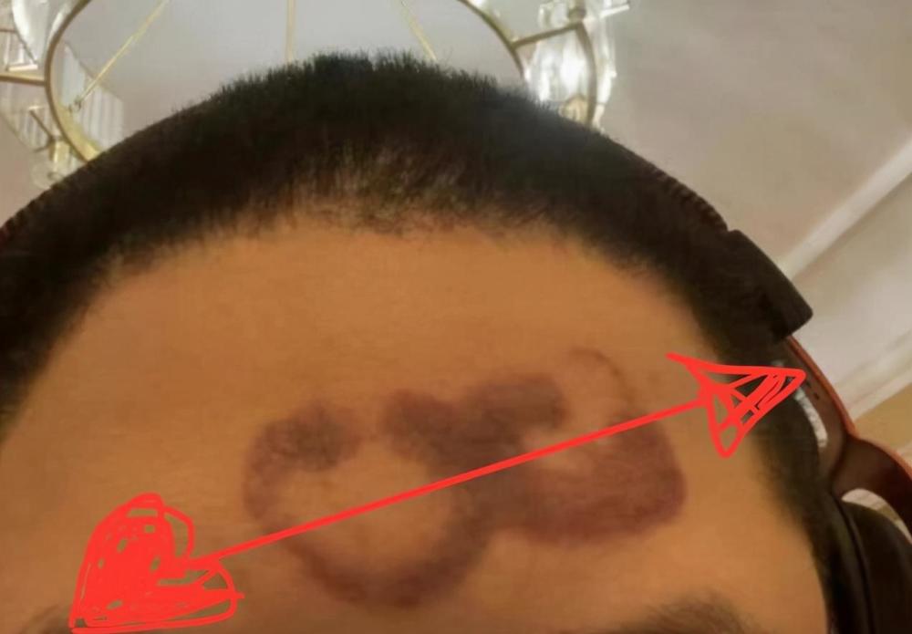 因拔罐用力过猛,pdd正式宣布停播!晒出脑门疤痕让粉丝哭笑不得