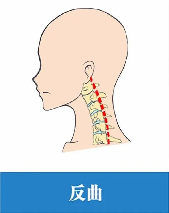 颈椎反曲了怎么办教你3招恢复颈椎生理曲度