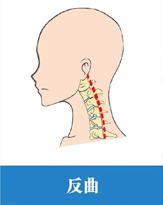 教你3招恢復頸椎生理曲度!