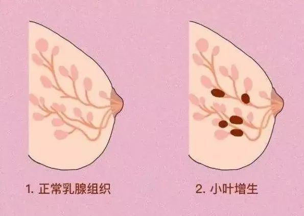 乳腺小葉增生——廣大女性的困擾