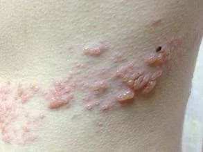 杭州一位新手妈妈腰上长出红斑家里老人一看紧张极了