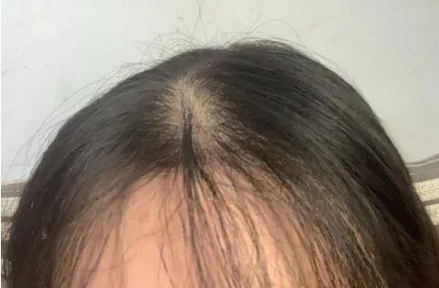 头发稀少是什么原因导致的?