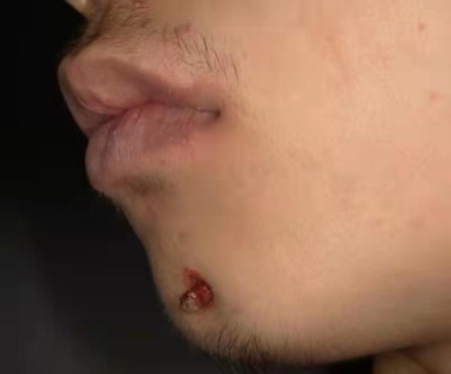 长沙17岁男孩下巴长出了"肉芽",病因竟出在牙齿上