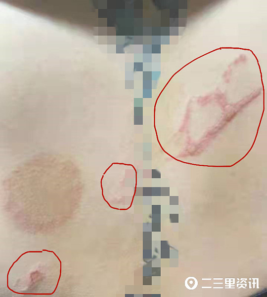 可没想到在做拔火罐的时候背部被烫伤