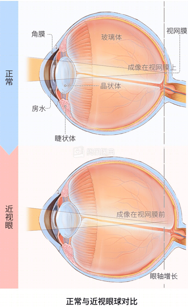 眼轴变化图图片