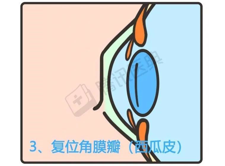 做完近视手术有后遗症吗？看看第一批做完的人……(图7)