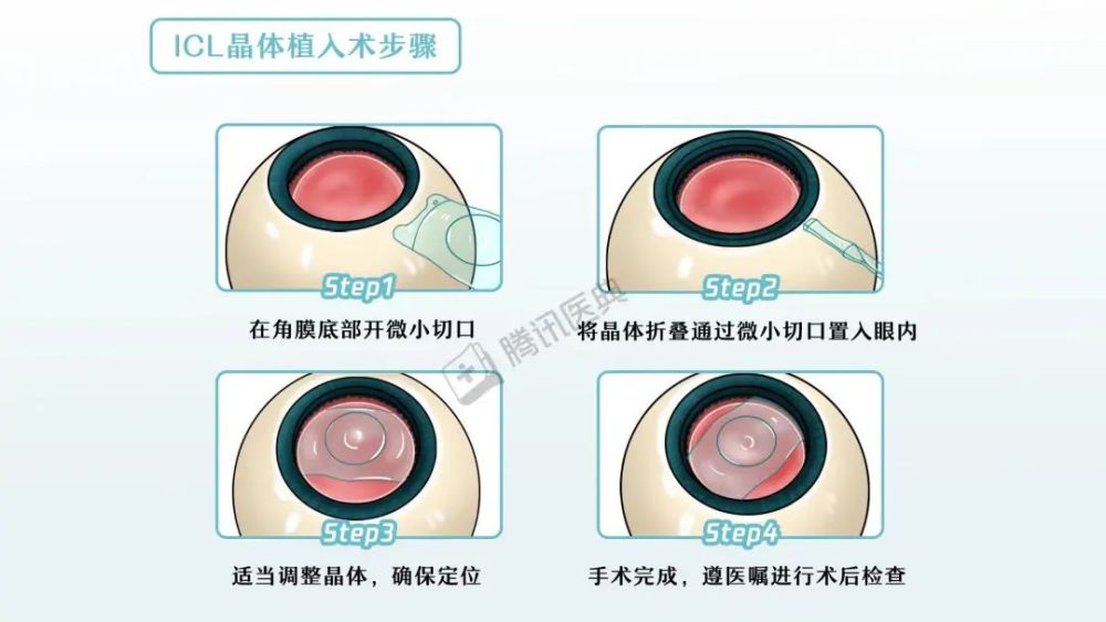 做完近视手术有后遗症吗？看看第一批做完的人……(图12)