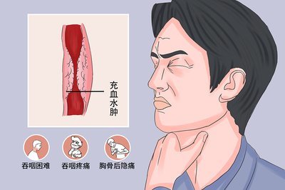 食管炎的症状表现有哪些