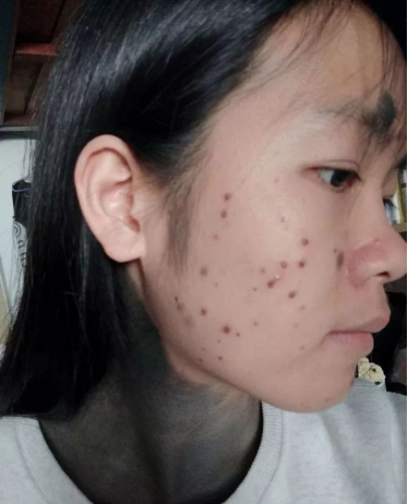 她一出生长满500颗痣,曾经被称作"斑点女孩",现在长成怎么样_腾讯新闻