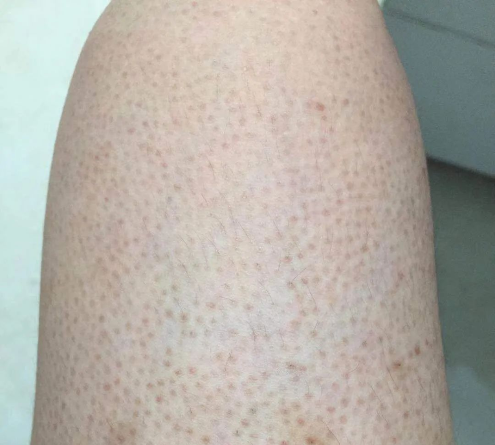 毛周角化最常见于脸颊,手臂,大腿外侧,一般表现为与毛孔一致的淡褐色