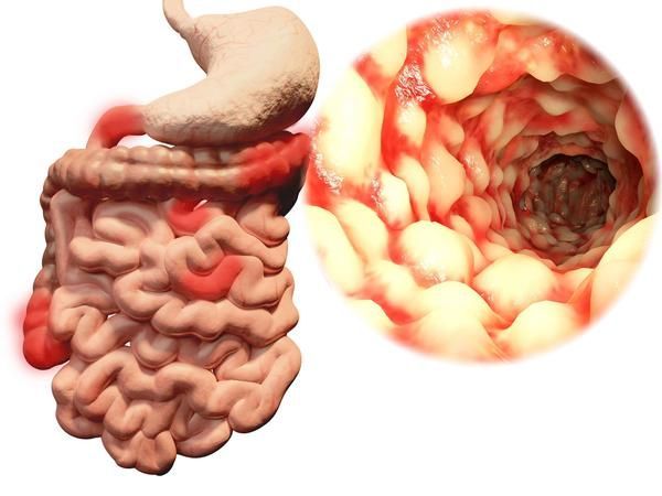 結腸癌並非突然而來醫生告誡身體出現3種異常儘快檢查腸鏡