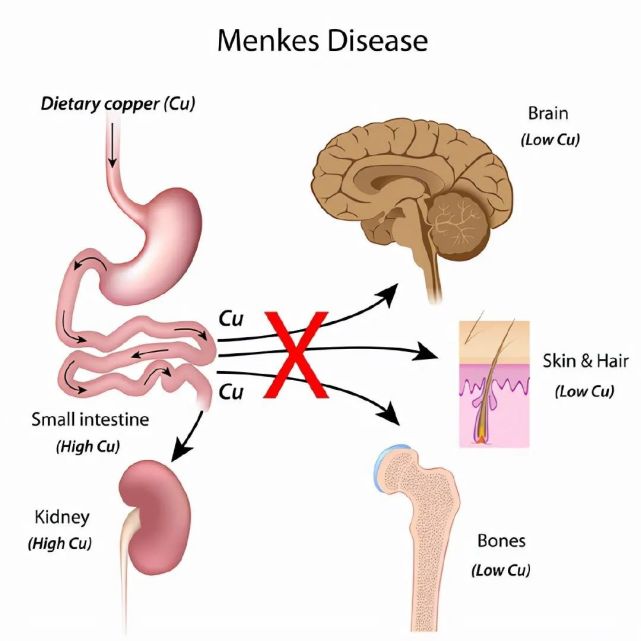 事件的主人公是一对父子,孩子在6个月大的时候,被诊断为"menkes综合症