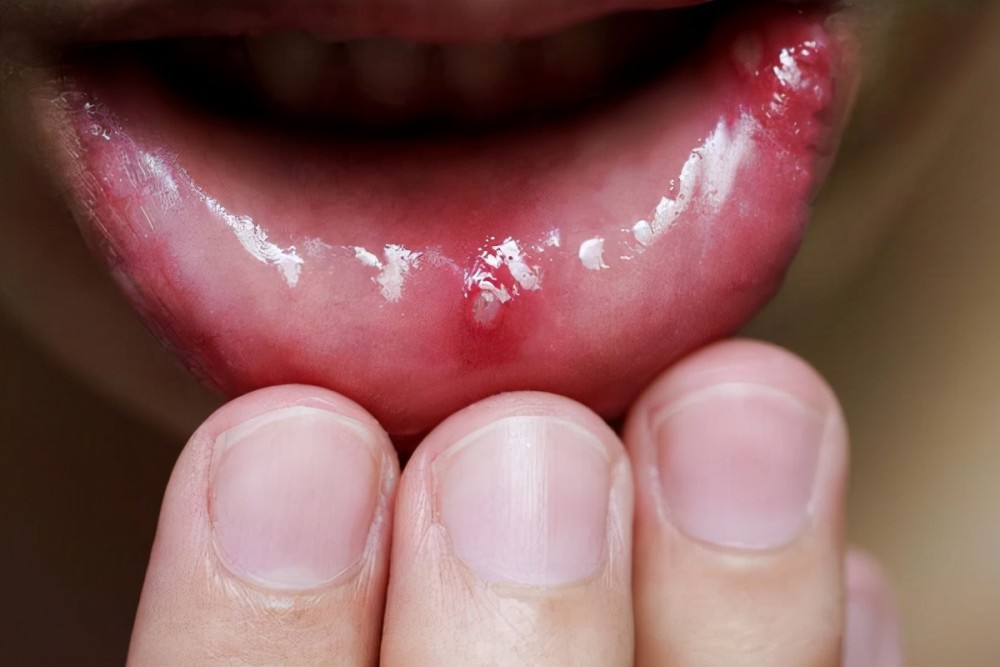 口腔溃疡确诊舌癌!
