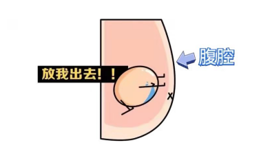 儿子蛋蛋不见了小儿外科专家很可能是隐睾症