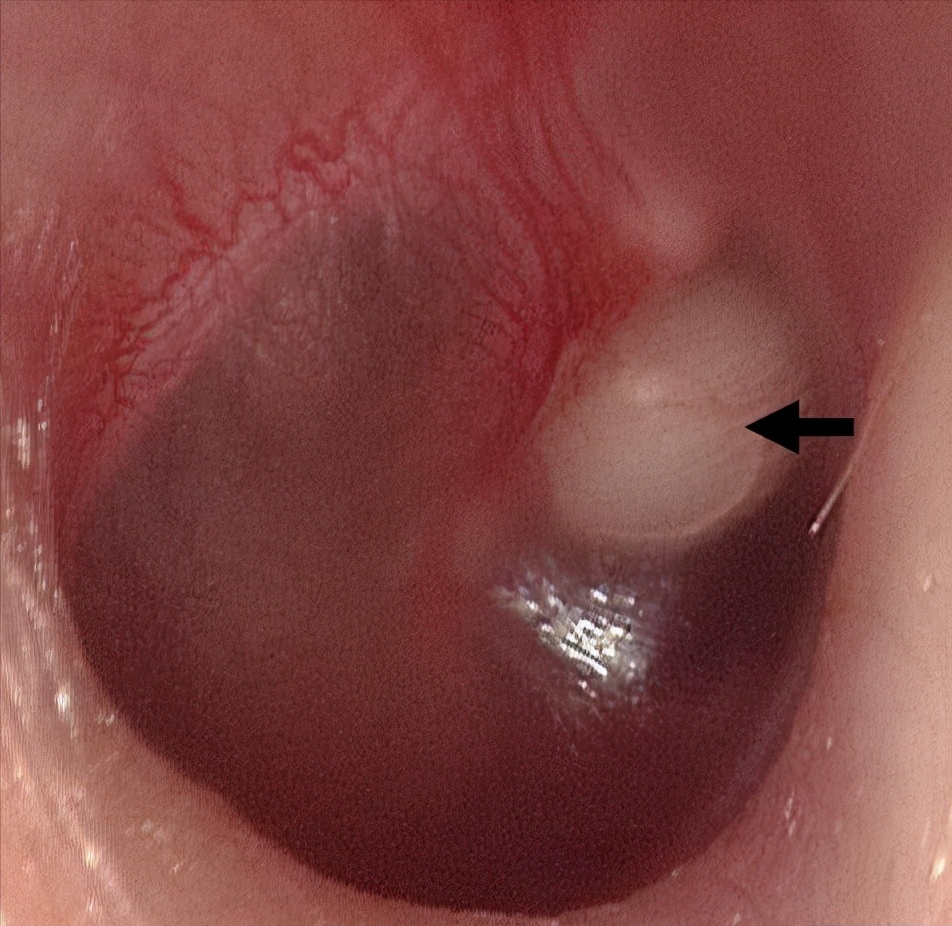但是鼓膜表面有个小小的白色球形凸起,表面很光滑,看起来还真像珍珠.