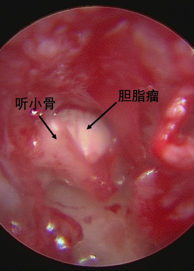 兒研所兒醫說孩子耳朵里長出珍珠