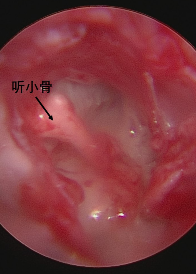 【儿研所儿医说】孩子耳朵里长出珍珠?