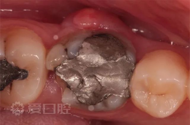 下颌第一磨牙根管治疗 树脂充填,第二前磨牙树脂充填1例 附11个月后