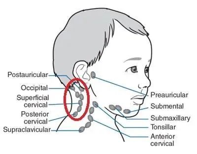 孩子耳后,颈部长这种鼓包是什么问题?需要担心吗?