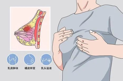 乳房肿块≠乳腺癌,触摸到的乳房肿块80%以上为良性,但是发现乳房肿块