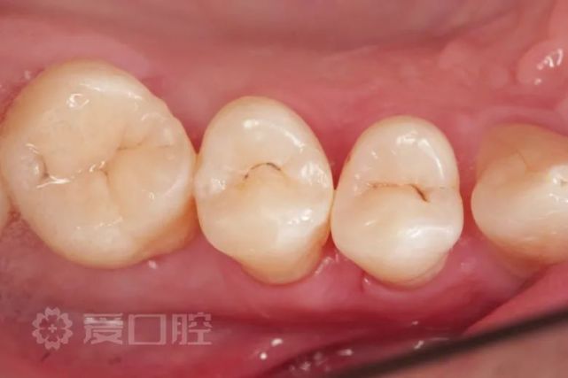 上颌第一前磨牙二类洞树脂充填1例