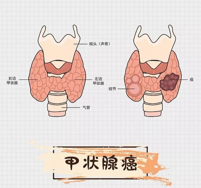 甲状腺癌为什么被称之为"懒癌"?