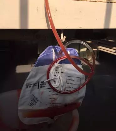 患者家属说尿袋里的尿液是从 14 日下午开始留下来的.