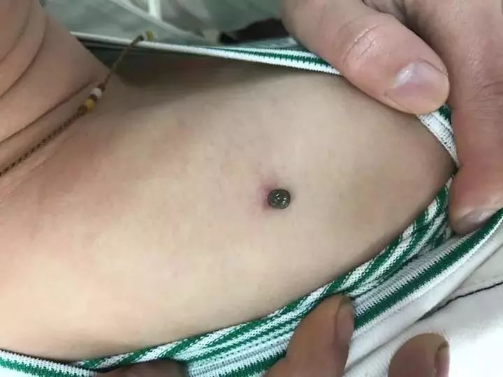 有被叮咬过的吗?蜱虫号称世界十大恐怖动物之一.