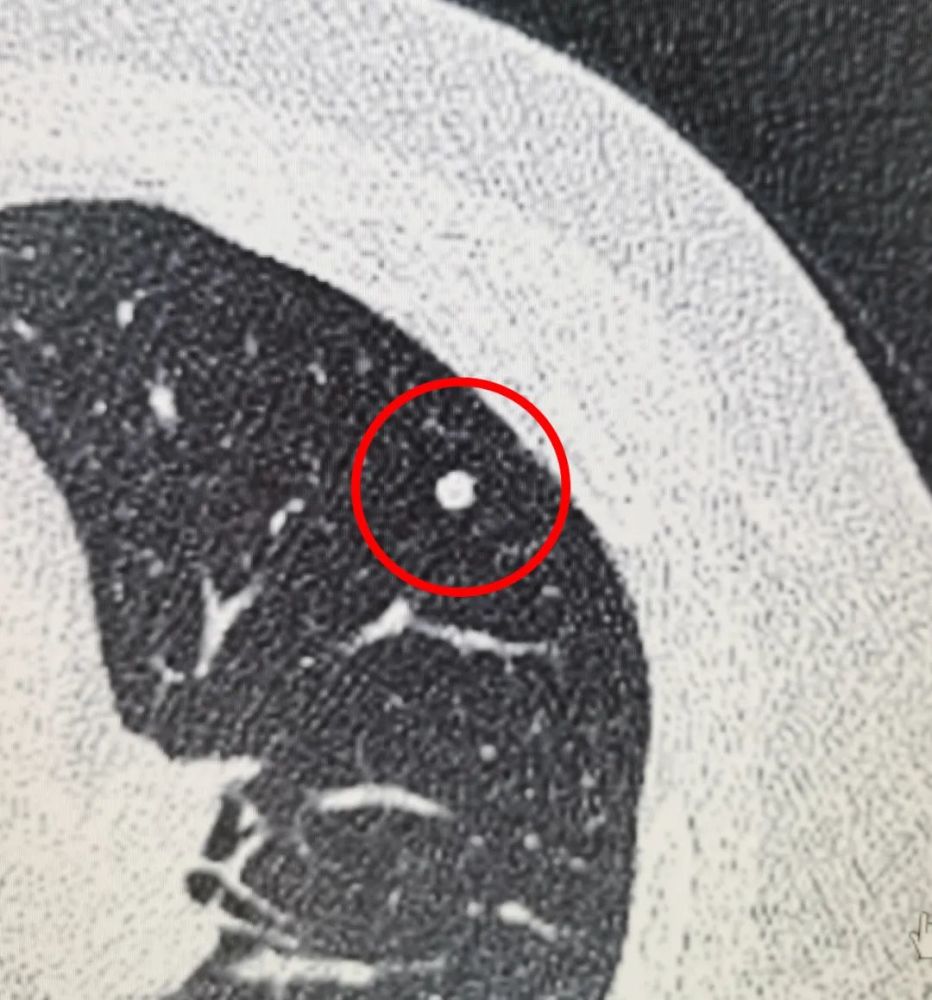 揭开"肺结节"的神秘面纱