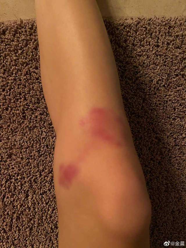 金晨晒练舞照,膝盖满是红肿令人心疼!
