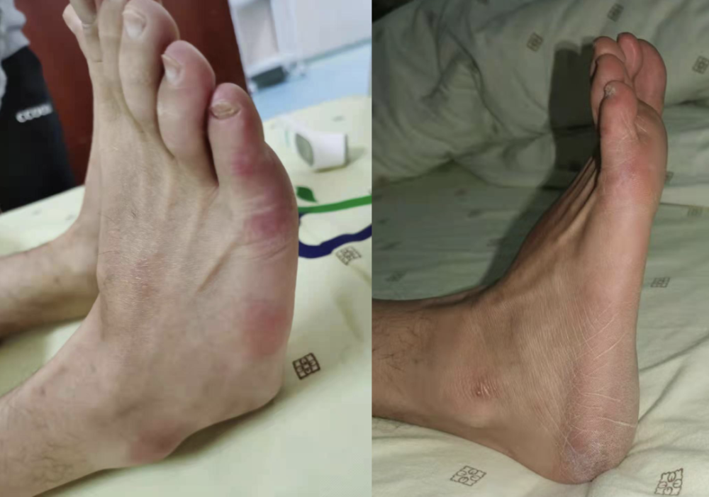 好消息糖尿病足下肢缺血以及痛性糖尿病神经病变有了新的治疗方法