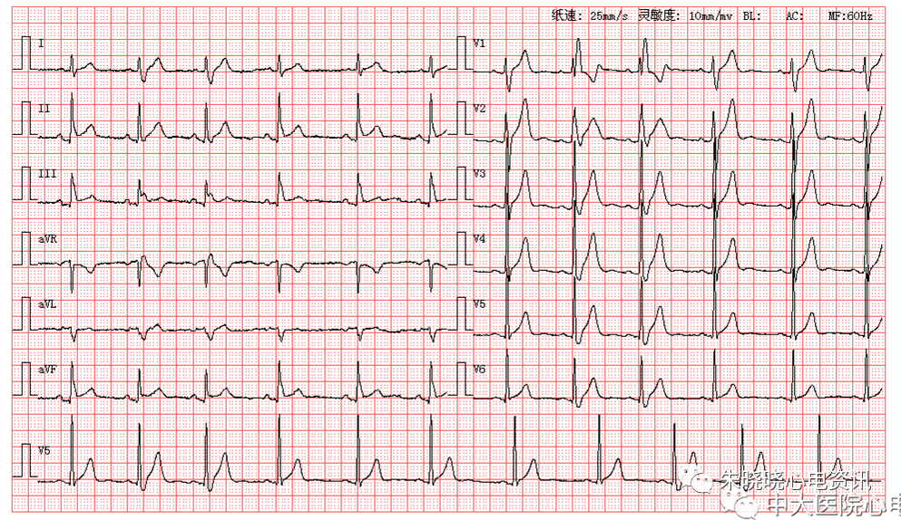 每日读图|第1532期 交界性早搏