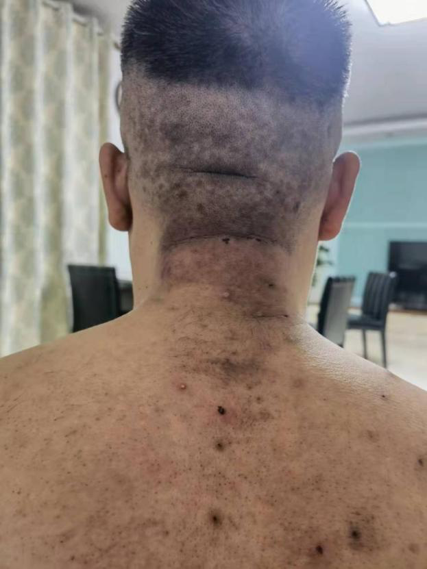 百年传承顿氏【挑羊毛疔】高级班_腾讯新闻