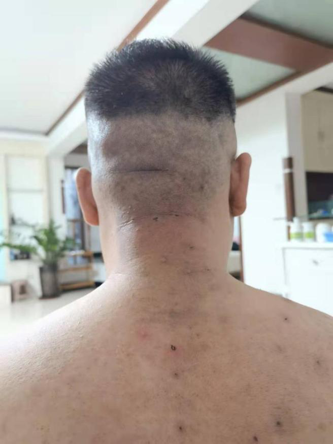 挑治区域:大椎,风池,天柱,肩井区羊毛疔病灶点一次挑治完毕,症状就没